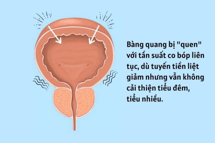 Vậy tại sao khi kích thước tuyến tiền liệt đã trở về bình thường rồi mà tình trạng tiểu đêm vẫn không c 1 Vậy tại sao khi kích thước tuyến tiền liệt đã trở về bình thường rồi mà tình trạng tiểu đêm vẫn không c 1