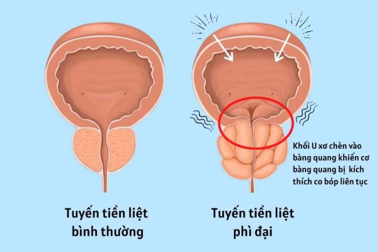 Vì sao phẫu thuật tuyến tiền liệt rồi mà tình trạng tiểu đêm vẫn không cải thiện? 1 Vì sao phẫu thuật tuyến tiền liệt rồi mà tình trạng tiểu đêm vẫn không cải thiện? 1