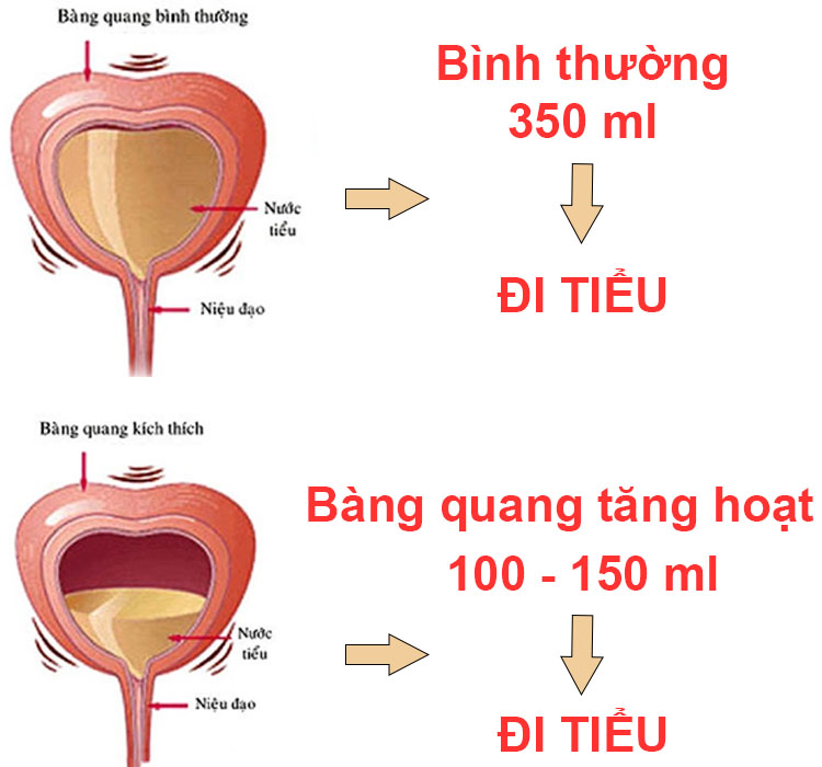 Bàng quang tăng hoạt (OAB) là bệnh gì? 1 Bàng quang tăng hoạt là nguyên nhân chủ yếu gây tình trạng tiểu đêm, tiểu són ở người già