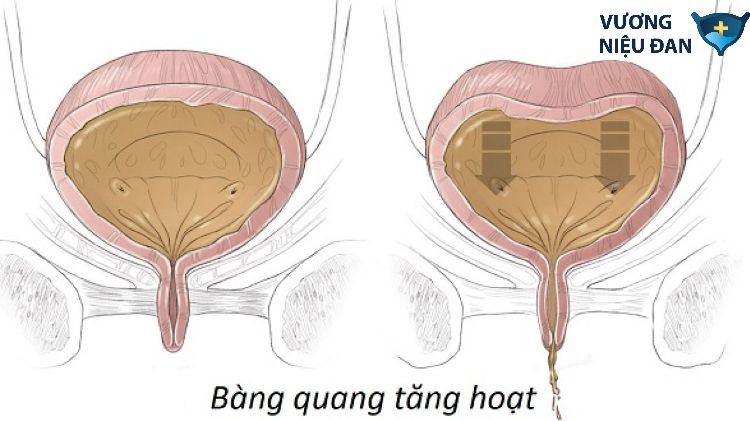 Bệnh bàng quang tăng hoạt có thể gây ra bởi nhiều nguyên nhân khác nhau