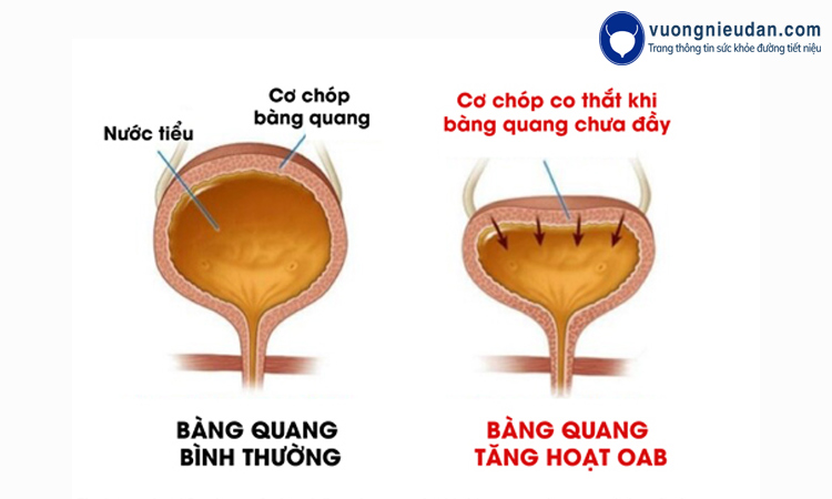 Triệu chứng khi mắc bàng quang tăng hoạt 1