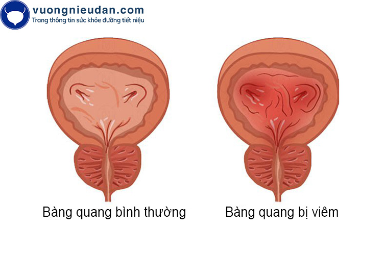 Viêm bàng quang 1