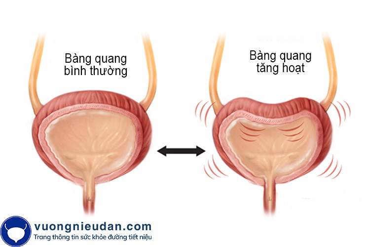 Bàng quang tăng hoạt 1