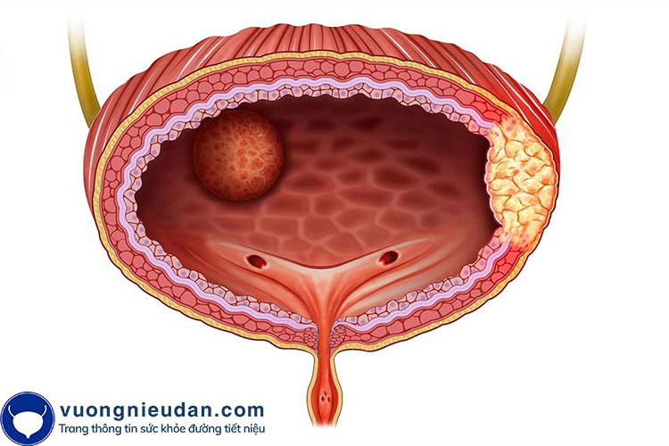 Tổn thương bàng quang 1