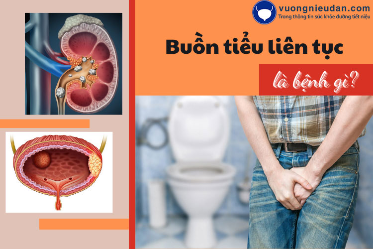 Buồn đi tiểu liên tục là bệnh gì? Có nguy hiểm không?