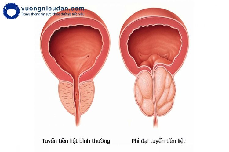 U xơ tuyến tiền liệt 1