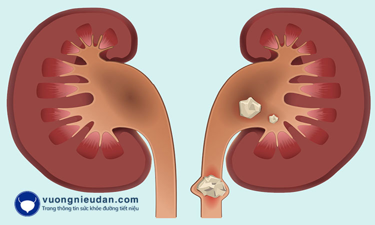 Tình trạng bàng quang tăng hoạt kéo dài có thể tăng nguy cơ mắc sỏi tiết niệu.