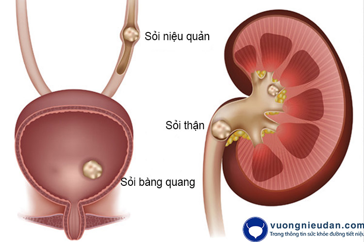 Sỏi tiết niệu 1