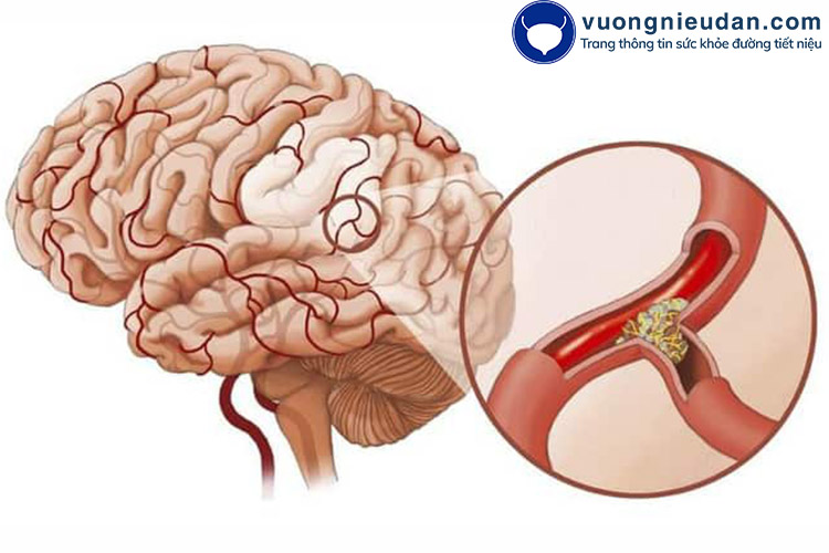 Thần kinh suy yếu 1