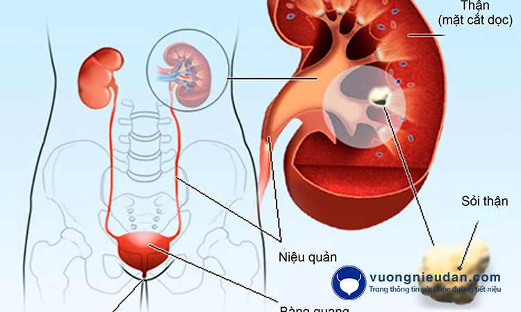 11. Sỏi đường tiết niệu 1