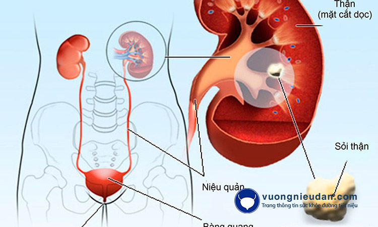 Sỏi đường tiết niệu 1