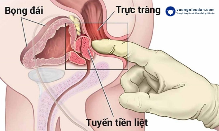 Tăng sinh lành tính tuyến tiền liệt là một trong những nguyên nhân gây đi tiểu đêm mất ngủ