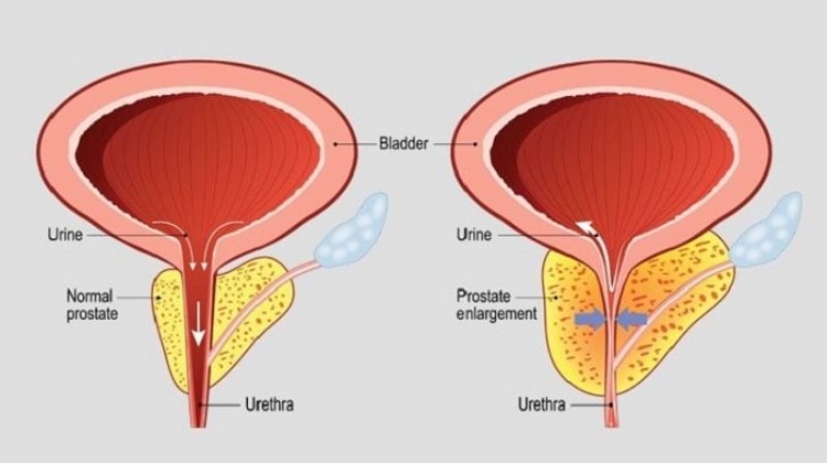 Phì đại tuyến tiền liệt có thể làm thành bàng quang dày lên