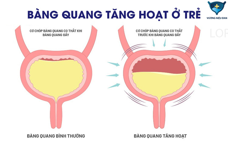 Tìm hiểu đôi nét về bàng quang tăng hoạt ở trẻ em