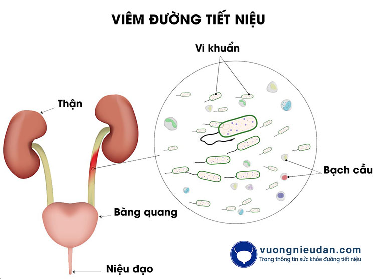 Viêm đường tiết niệu là tình trạng vi khuẩn xâm nhập vào đường tiết niệu thông qua niệu quản