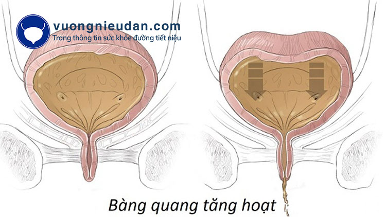 Bàng quang tăng hoạt