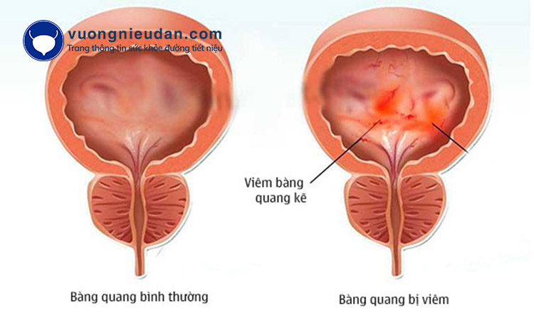 Viêm đường tiết niệu 1