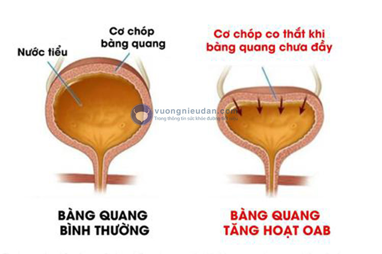 Do bàng quang tăng hoạt 1