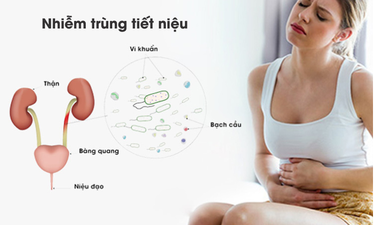 UTI là một trong những nguyên nhân chính gây nên tình trạng mắc tiểu liên tục nhưng tiểu ít ở nữ