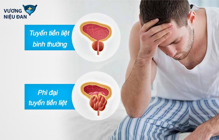 Khi bị tiền liệt tuyến, người bệnh thường có cảm giác buồn đi tiểu mặc dù không uống nhiều nước