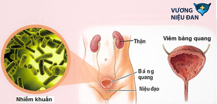 Nhịn tiểu đau bàng quang là triệu chứng của bệnh lý viêm bàng quang