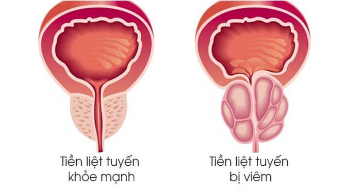 Viêm tuyến tiền liệt nguyên nhân phổ biến gây tiểu gấp ở nam giới 