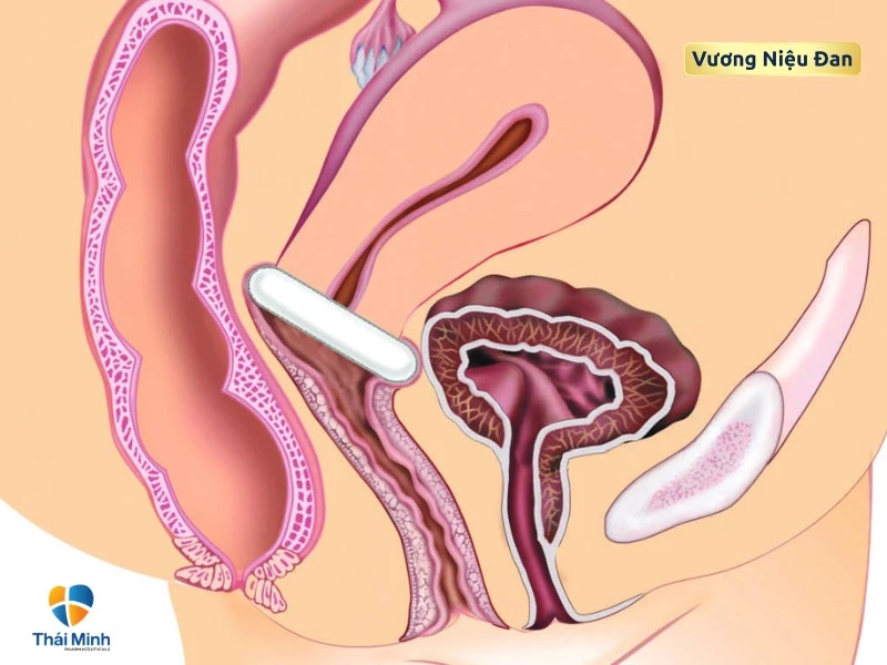 đặt vòng nâng niệu đạo