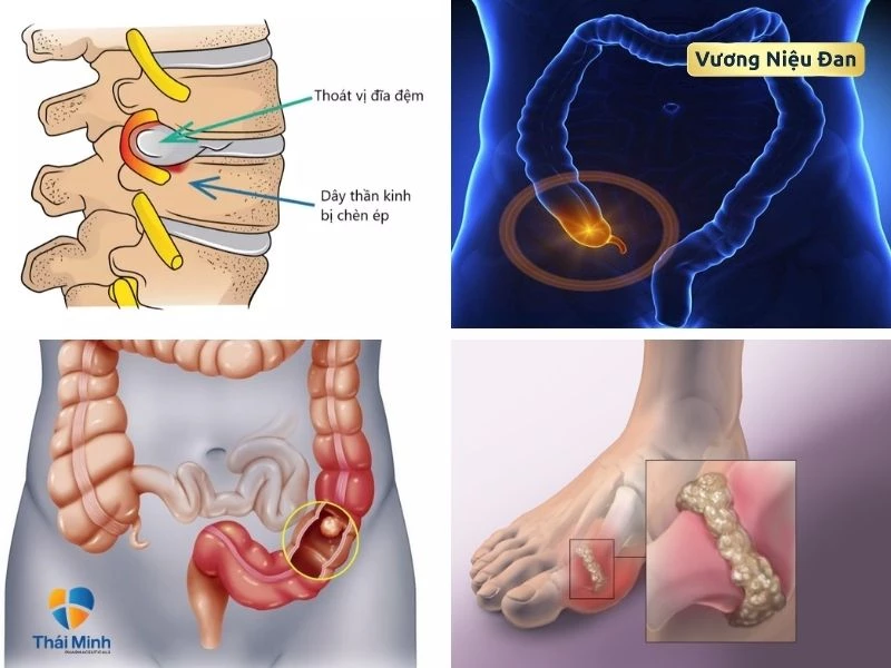 Bệnh lý gây đau bụng dưới, đau lưng