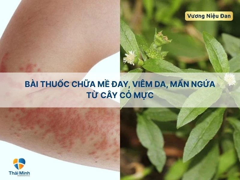 Bài thuốc trị mề đay với cây cỏ mực