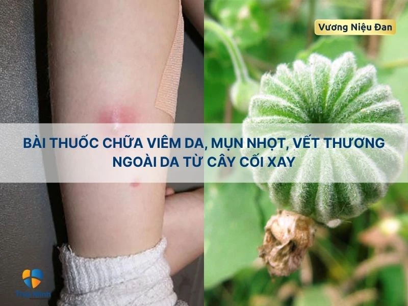 Chữa viêm da, mụn nhọt với cây cối xay