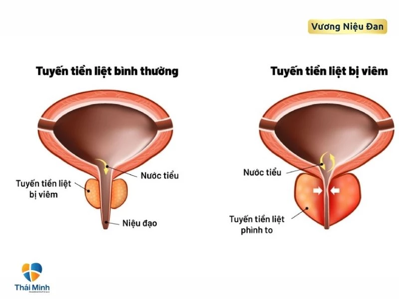 Viêm tuyến tiền liệt nam giới gây tiểu buốt